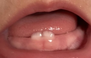 乳歯2本の口の中